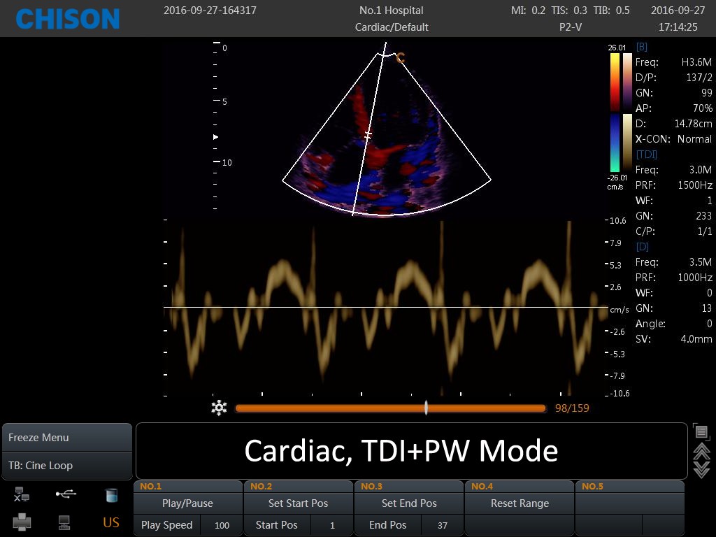 SonoBook Cardiac TDI PW